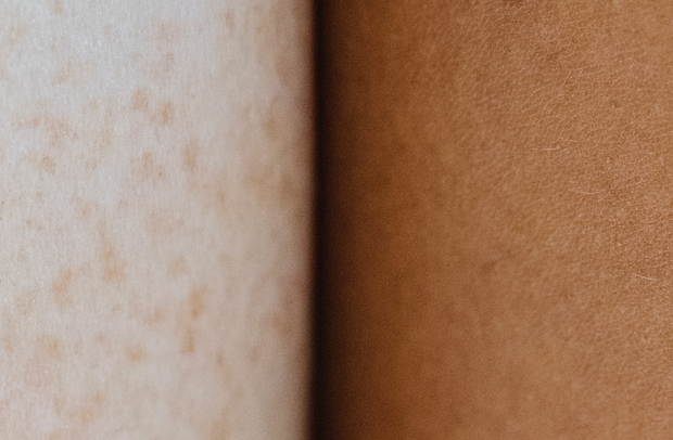 Holistic Solutions for Eczema Relief: From true eczema sufferers